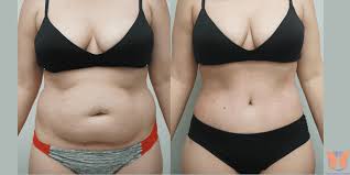 Liposuction in Shahdol