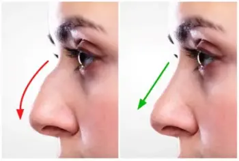 Rhinoplasty in Buldhana