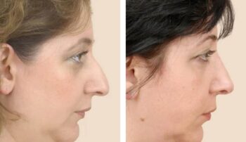 Rhinoplasty in washim