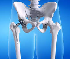 Robotic Hip Replacement In Shajapur