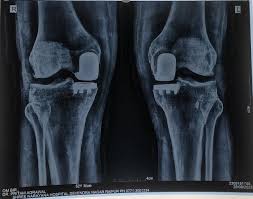 Robotic Joint Replacement in Raipur
