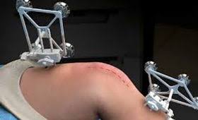 Robotic Joint Replacement in Sarangarh-Bilaigarh