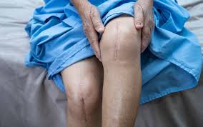 Robotic Knee Replacement In Damoh