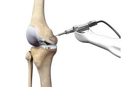 Robotic joint replacement in Pithampur